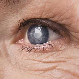 Catacts Eye Clinic In Vaughan & Woodbridge
