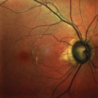 Glaucoma Eye Exam In Vaughan & Woodbridge